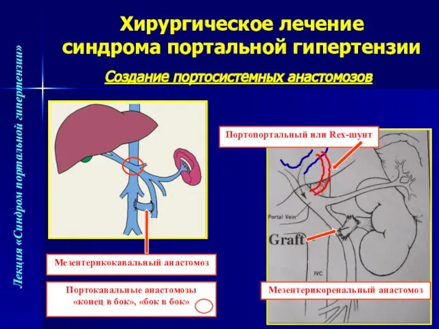 Хирургическое лечение синдрома портальной гипертензии Создание портосистемных анастомозов Портопортальный или Rex-шунт