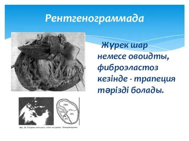 Рентгенограммада Жүрек шар немесе овоидты, фиброэластоз кезінде - трапеция тәрізді болады.