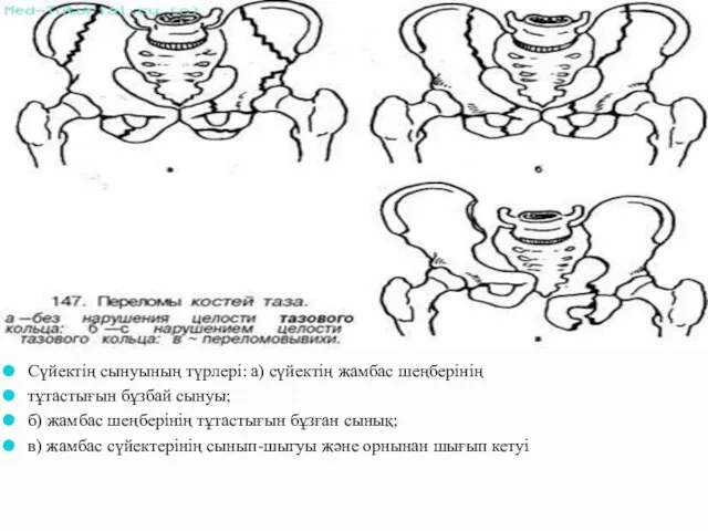 Сүйектің сынуының түрлері: а) сүйектің жамбас шеңберінің тұтастығын бұзбай сынуы; б)
