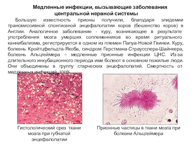 Медленные инфекции, вызывающие заболевания центральной нервной системы Большую известность прионы получили,