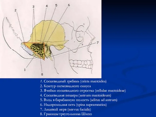 1. Сосцевидный гребень (crista mastoidea) 2. Контур сигмовидного синуса 3. Ячейки