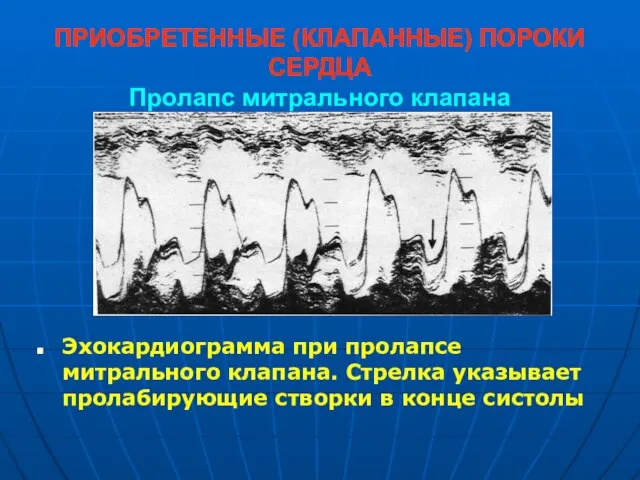 ПРИОБРЕТЕННЫЕ (КЛАПАННЫЕ) ПОРОКИ СЕРДЦА Пролапс митрального клапана Эхокардиограмма при пролапсе митрального