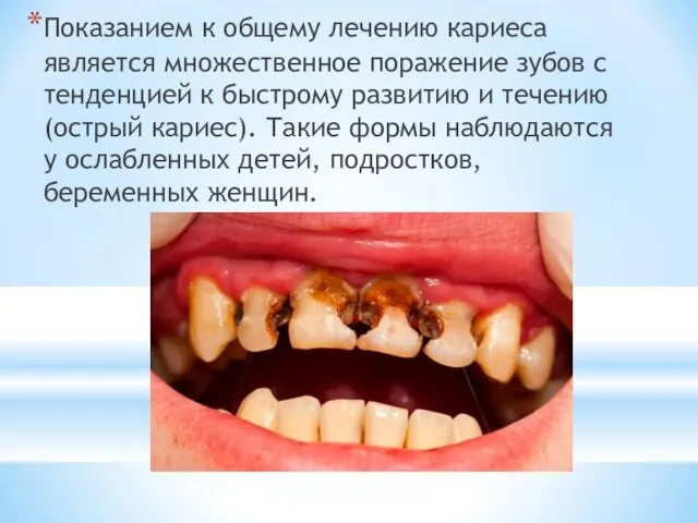 Показанием к общему лечению кариеса является множественное поражение зубов с тенденцией