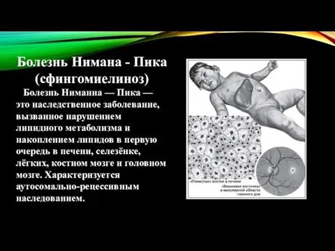 Болезнь Нимана - Пика (сфингомиелиноз) Болезнь Ниманна — Пика — это