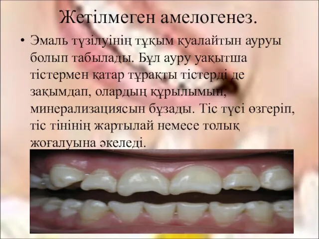 Эмаль түзілуінің тұқым қуалайтын ауруы болып табылады. Бұл ауру уақытша тістермен