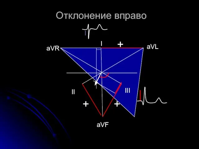 Отклонение вправо aVL аVR aVF I II III + + +