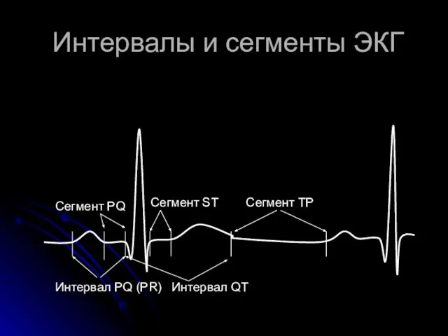 Интервалы и сегменты ЭКГ Интервал PQ (PR) Сегмент ST Сегмент PQ Интервал QT Сегмент ТР