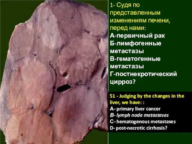 1- Судя по представленным изменениям печени, перед нами: А-первичный рак Б-лимфогенные