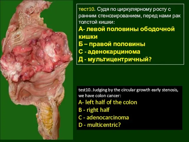 тест10. Судя по циркулярному росту с ранним стенозированием, перед нами рак