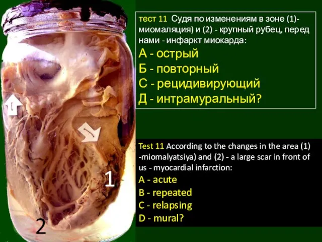 1 2 тест 11 Судя по изменениям в зоне (1)-миомаляция) и