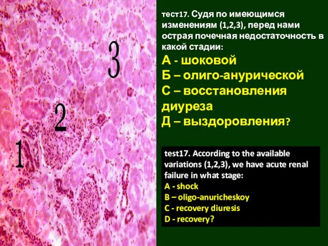 тест17. Судя по имеющимся изменениям (1,2,3), перед нами острая почечная недостаточность