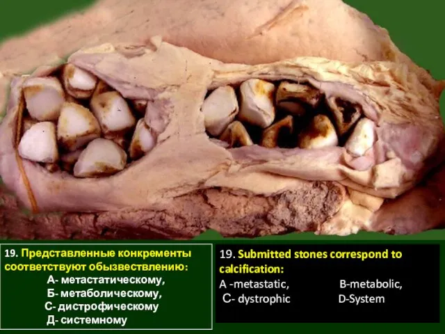 19. Представленные конкременты соответствуют обызвествлению: А- метастатическому, Б- метаболическому, С- дистрофическому