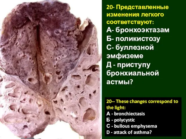 20- Представленные изменения легкого соответствуют: А- бронхоэктазам Б- поликистозу С- буллезной