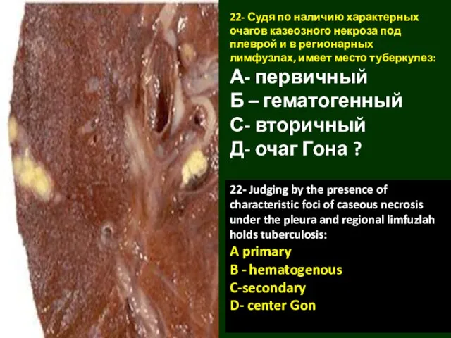 22- Судя по наличию характерных очагов казеозного некроза под плеврой и