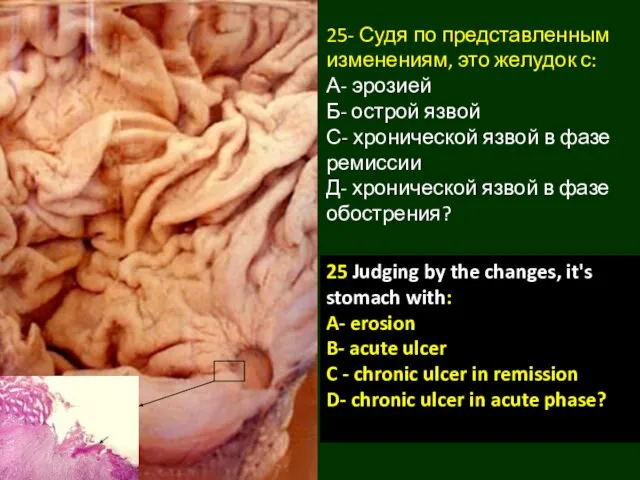 25- Судя по представленным изменениям, это желудок с: А- эрозией Б-