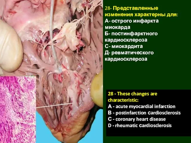 28- Представленные изменения характерны для: А- острого инфаркта миокарда Б- постинфарктного