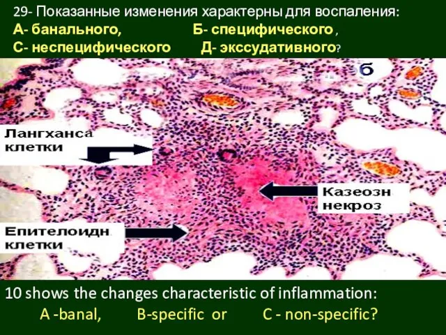 29- Показанные изменения характерны для воспаления: А- банального, Б- специфического ,