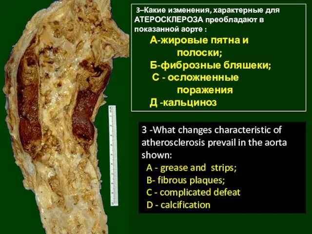3–Какие изменения, характерные для АТЕРОСКЛЕРОЗА преобладают в показанной аорте : А-жировые