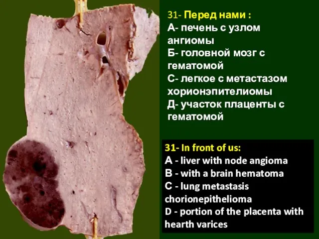 31- Перед нами : А- печень с узлом ангиомы Б- головной