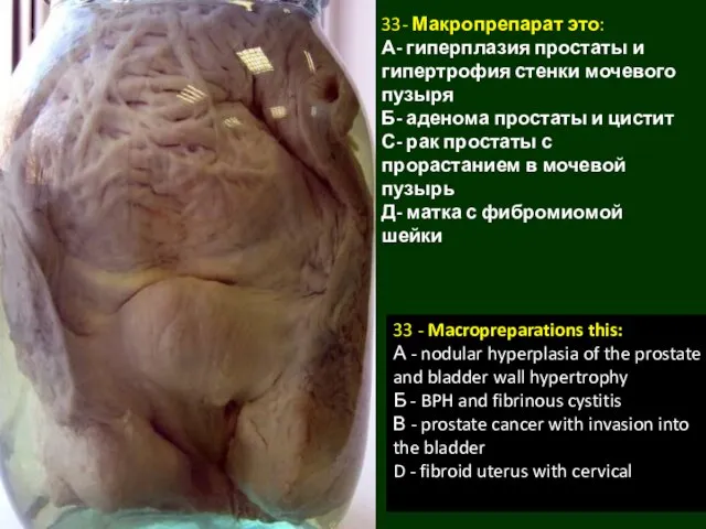 33- Макропрепарат это: А- гиперплазия простаты и гипертрофия стенки мочевого пузыря