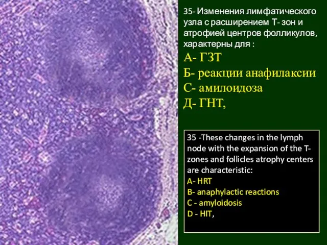 35- Изменения лимфатического узла с расширением Т- зон и атрофией центров