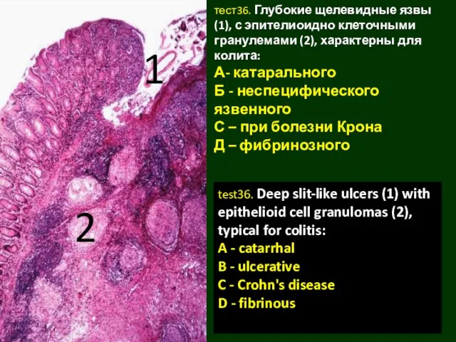 тест36. Глубокие щелевидные язвы (1), с эпителиоидно клеточными гранулемами (2), характерны