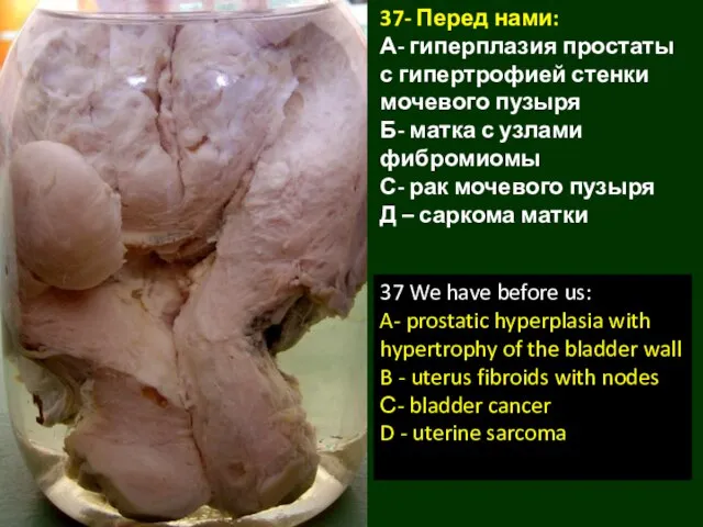 37- Перед нами: А- гиперплазия простаты с гипертрофией стенки мочевого пузыря