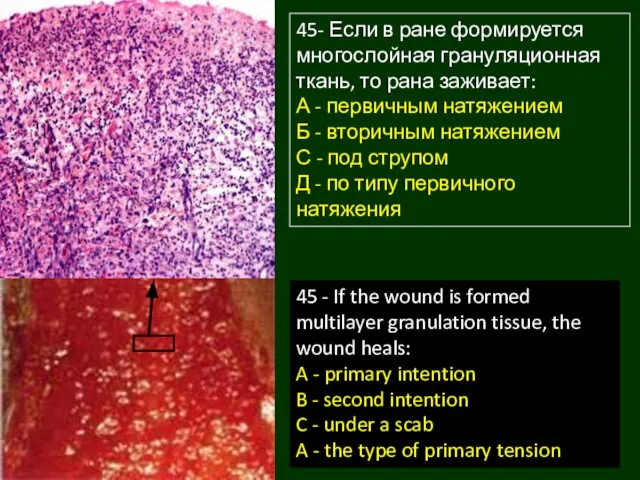 45- Если в ране формируется многослойная грануляционная ткань, то рана заживает: