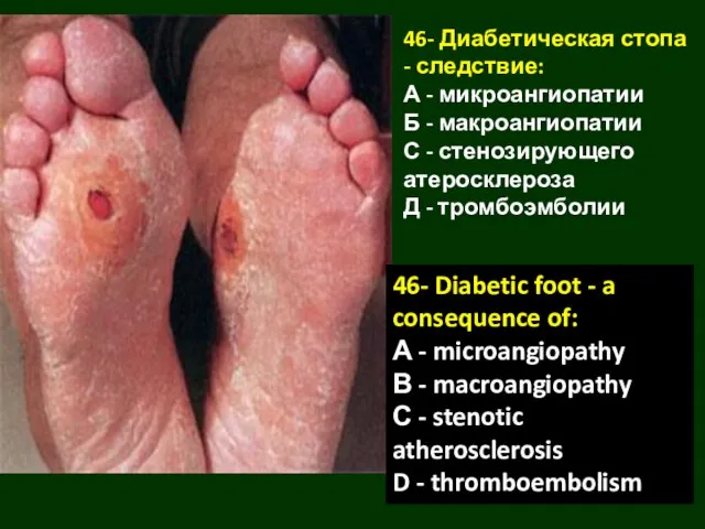 46- Диабетическая стопа - следствие: А - микроангиопатии Б - макроангиопатии