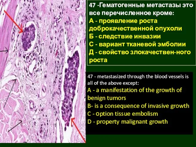 47 -Гематогенные метастазы это все перечисленное кроме: А - проявление роста