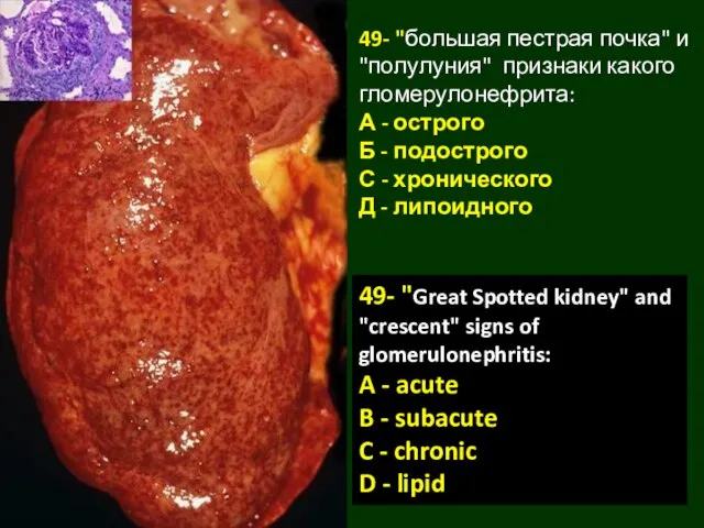 49- "большая пестрая почка" и "полулуния" признаки какого гломерулонефрита: А -