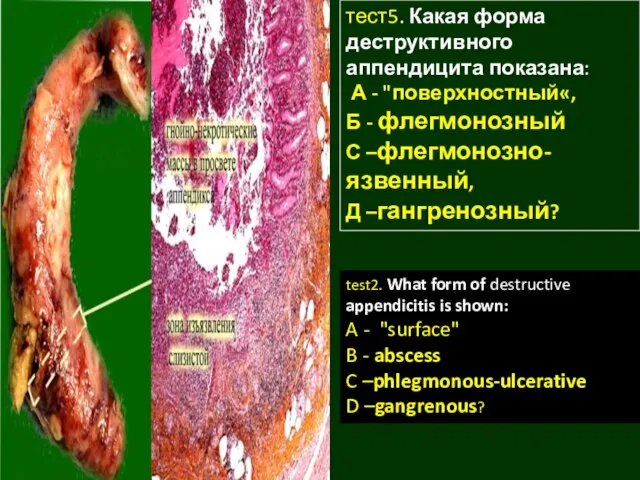 тест5. Какая форма деструктивного аппендицита показана: А - "поверхностный«, Б -