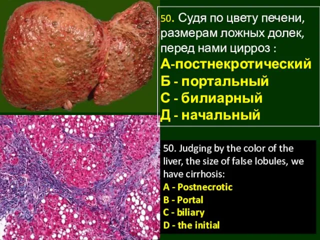 50. Судя по цвету печени, размерам ложных долек, перед нами цирроз