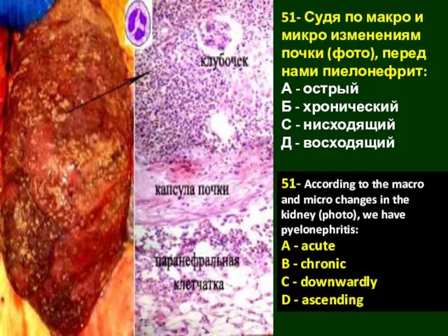 51- Судя по макро и микро изменениям почки (фото), перед нами