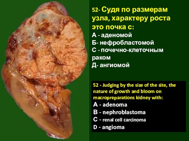 52- Судя по размерам узла, характеру роста это почка с: А