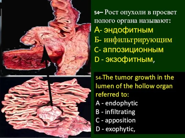 54– Рост опухоли в просвет полого органа называют: А- эндофитным Б-