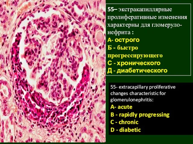 55– экстракапиллярные пролиферативные изменения характерны для гломеруло-нефрита : A- острого Б