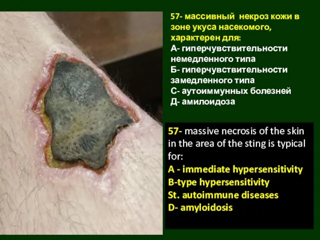 57- массивный некроз кожи в зоне укуса насекомого, характерен для: А-
