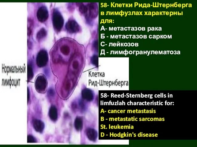 58- Клетки Рида-Штернберга в лимфузлах характерны для: А- метастазов рака Б