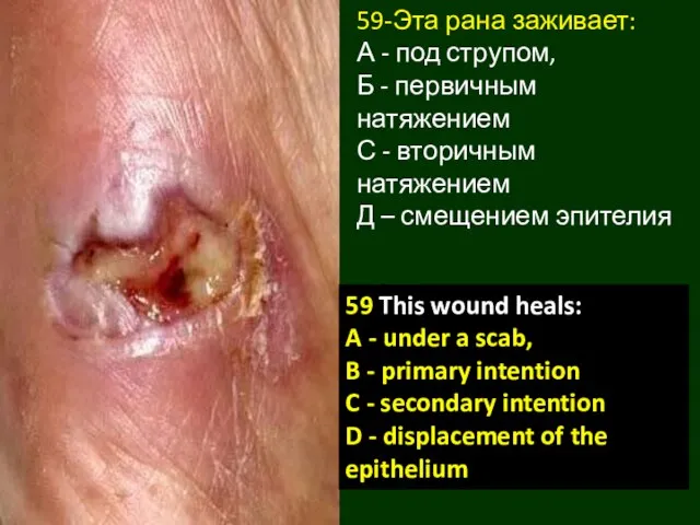 59-Эта рана заживает: А - под струпом, Б - первичным натяжением