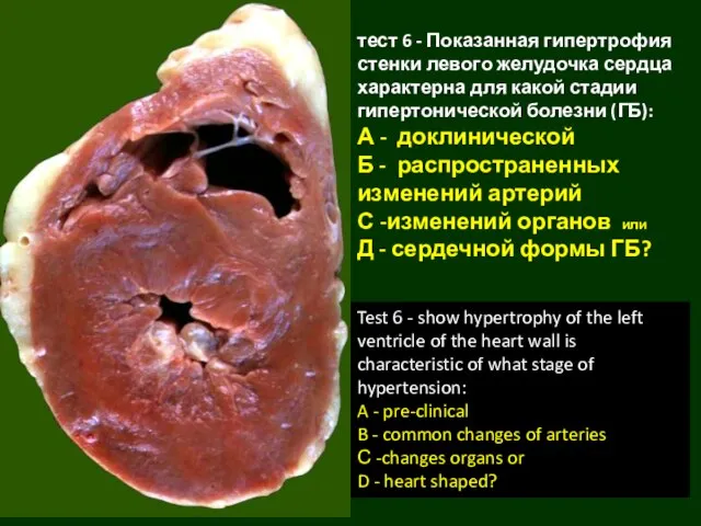 тест 6 - Показанная гипертрофия стенки левого желудочка сердца характерна для