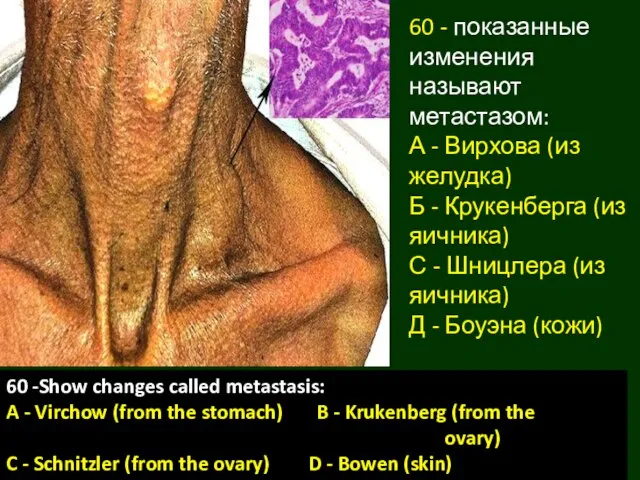 60 - показанные изменения называют метастазом: А - Вирхова (из желудка)