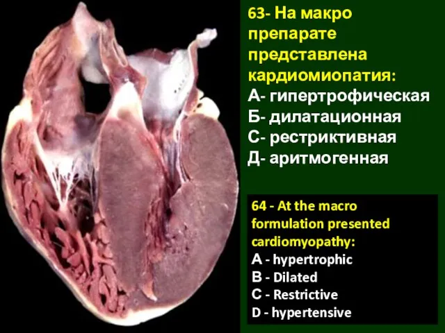 63- На макро препарате представлена кардиомиопатия: А- гипертрофическая Б- дилатационная С-