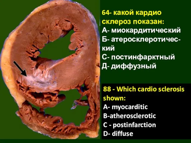 64- какой кардио склероз показан: А- миокардитический Б- атеросклеротичес-кий С- постинфарктный