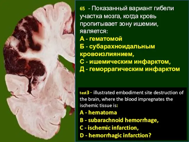 65 - Показанный вариант гибели участка мозга, когда кровь пропитывает зону