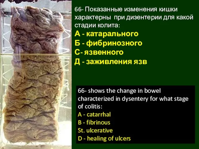 66- Показанные изменения кишки характерны при дизентерии для какой стадии колита: