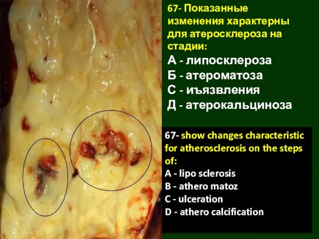 67- Показанные изменения характерны для атеросклероза на стадии: А - липосклероза