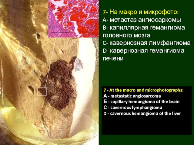 7- На макро и микрофото: A- метастаз ангиосаркомы B- капиллярная гемангиома