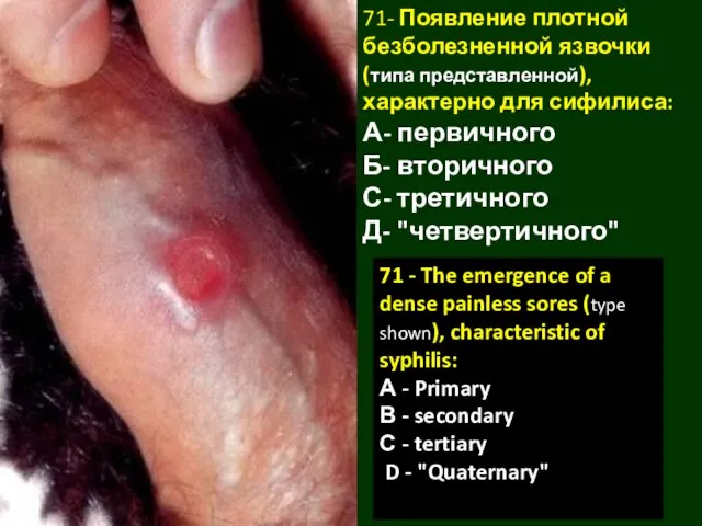 71- Появление плотной безболезненной язвочки (типа представленной), характерно для сифилиса: А-