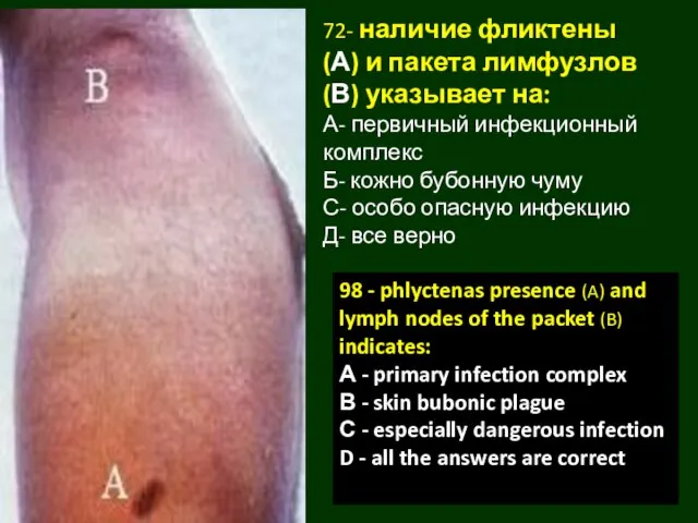 72- наличие фликтены (А) и пакета лимфузлов (В) указывает на: А-